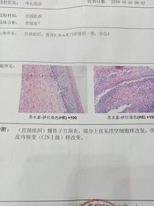 宫颈慢性炎细胞浸润是什么意思？宫径淋巴细胞浆细胞浸润如何治疗