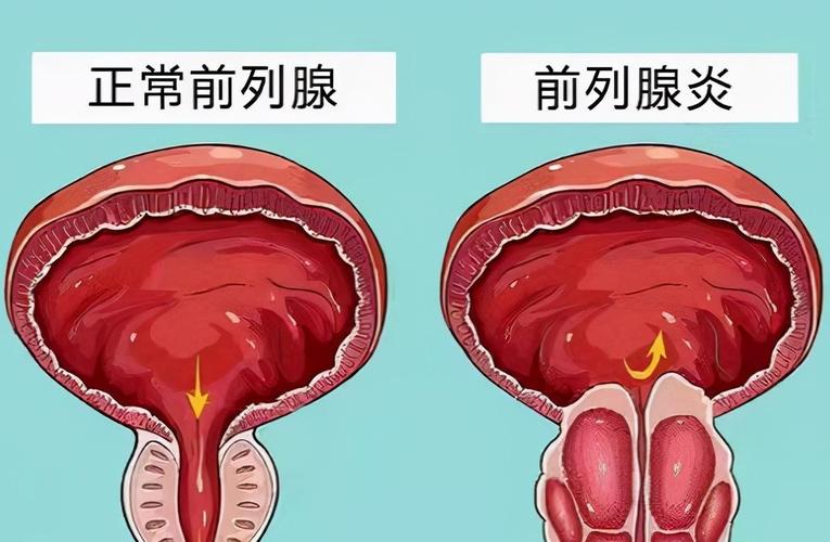 急性前列腺炎是怎么引起的？急性前列腺如何治疗好