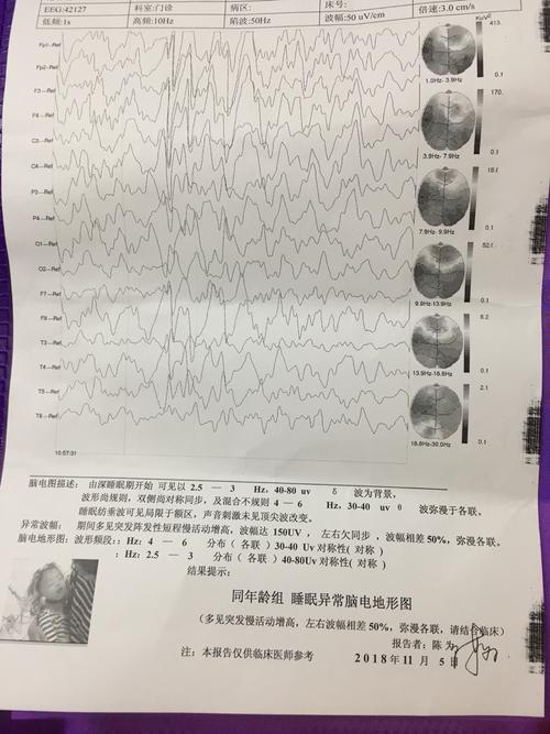 脑电波的引导与观察如何看脑电图报告