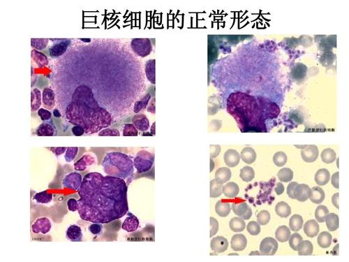 什么是核巨细胞？如何计数骨髓片中巨核细胞数量