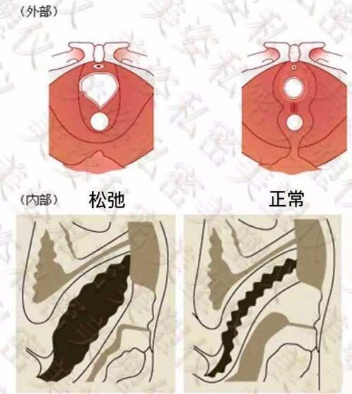 缩阴手术是如何操作的？阴道松弛如何收缩