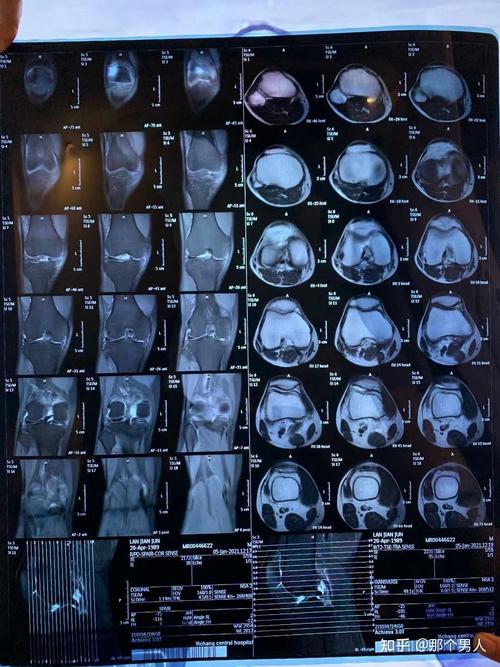 腿关节做ct和核磁共振区别？核磁共振疹断膝关节准确度如何