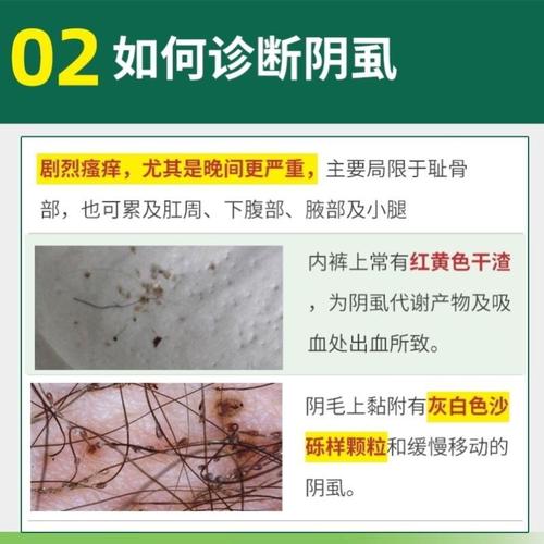 阴虱病怎么治？用什么药？如何检查阴虱