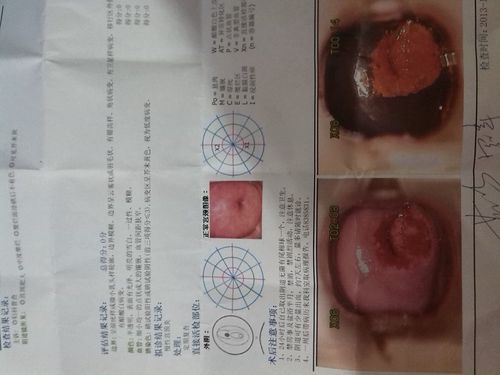 宫颈糜烂三度一定要手术吗？三度宫颈糜烂如何治