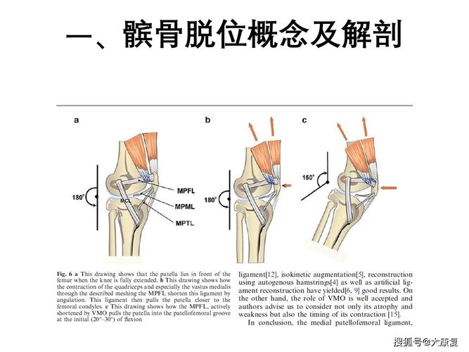 出现髌骨脱位，能不能直接给它掰回来？髌骨滑脱如何治疗