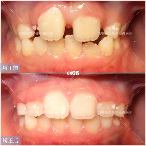 9岁儿童矫正两颗门牙中间缝隙大矫正可以吗？需要多少钱？门牙太大如何整形