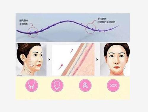 新型胶原蛋白埋线透皮技术靠谱吗？热玛吉除皱效果如何