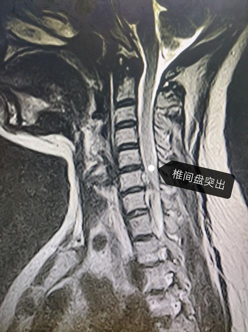 椎体前缘高度是什么意思？磁共振椎体如何定位