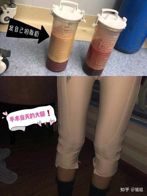 肚子吸脂对身体有什么危害吗？如何规避吸脂细臂副作用