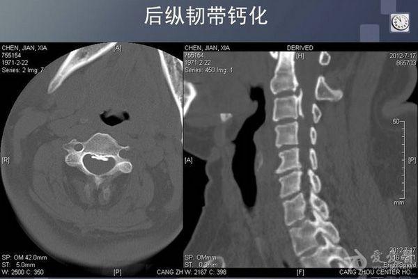 颈椎前纵韧带钙化，严重吗？后纵韧带钙化如何治疗