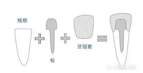 牙桩牙冠安装过程？牙冠如何固定