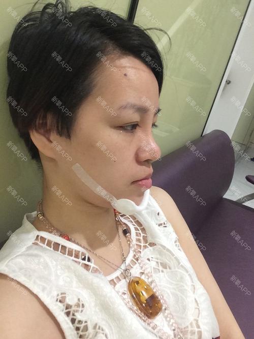 玻尿酸下巴消肿后会小一点么？深圳垫下巴整形后如何消肿