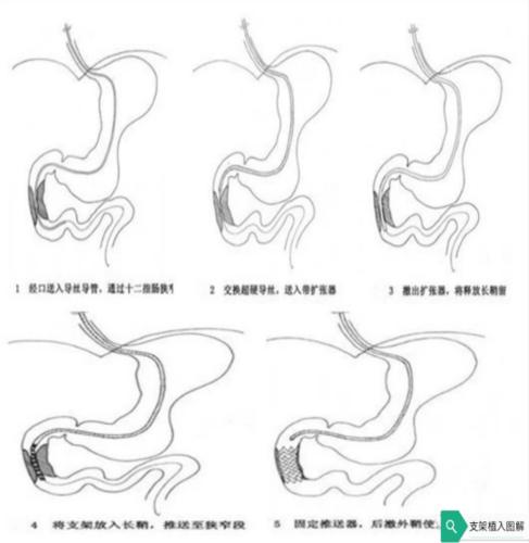 十二指肠梗阻的症状？肠梗阻如何支架治疗