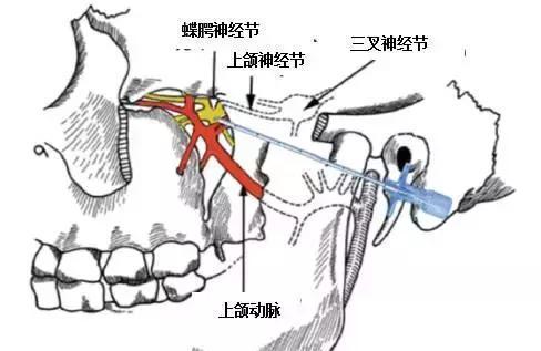 翼腭窝的位置？如何刺激蝶腭神经