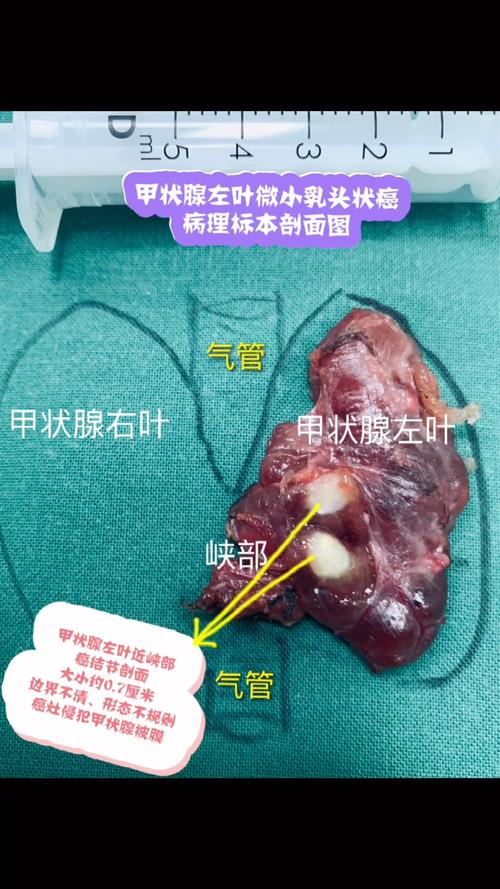 甲状腺缩小有什么问题？肝左叶缩小如何治疗