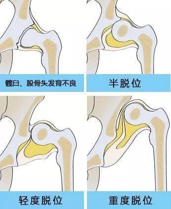 髋关节的构成结构特点？如何治疗新生儿分髋