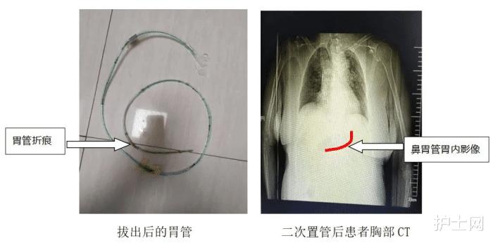 鼻胃管插入胃里的管子，是插深点好还是浅点？（肠内营养配制室标准）