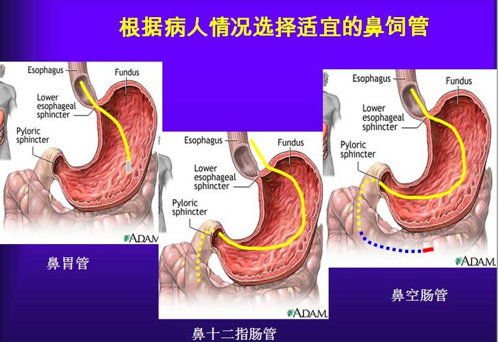 鼻胃管插入胃里的管子，是插深点好还是浅点？（肠内营养的输入）