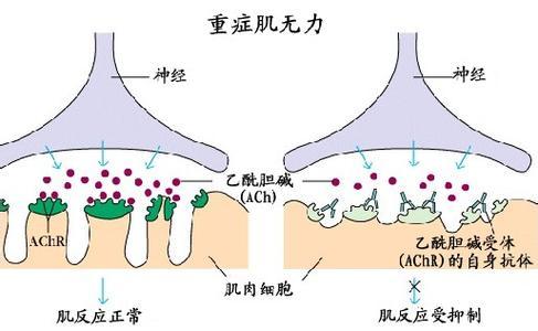 肌肉无力症是什么？（肌无力与肌营养不良）