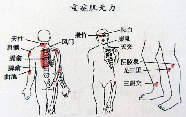 肌肉无力症是什么原因呀？（肌无力 肌营养不良）