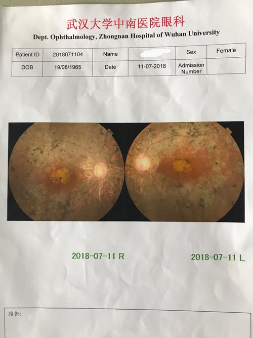 先天性视网膜色素变性怎么治疗？（先天性视网膜营养不良）