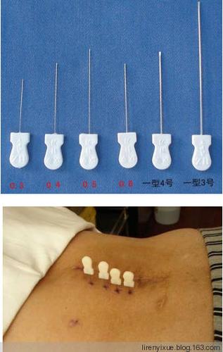 腰突针灸，理疗，小针刀哪个更好？（营养腰椎神经的针）