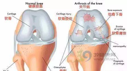 膝关节软骨磨损如何治疗？（软骨营养不良怎么调理）