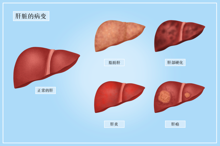 不均匀脂肪肝什么意思？（营养过剩型脂肪肝）