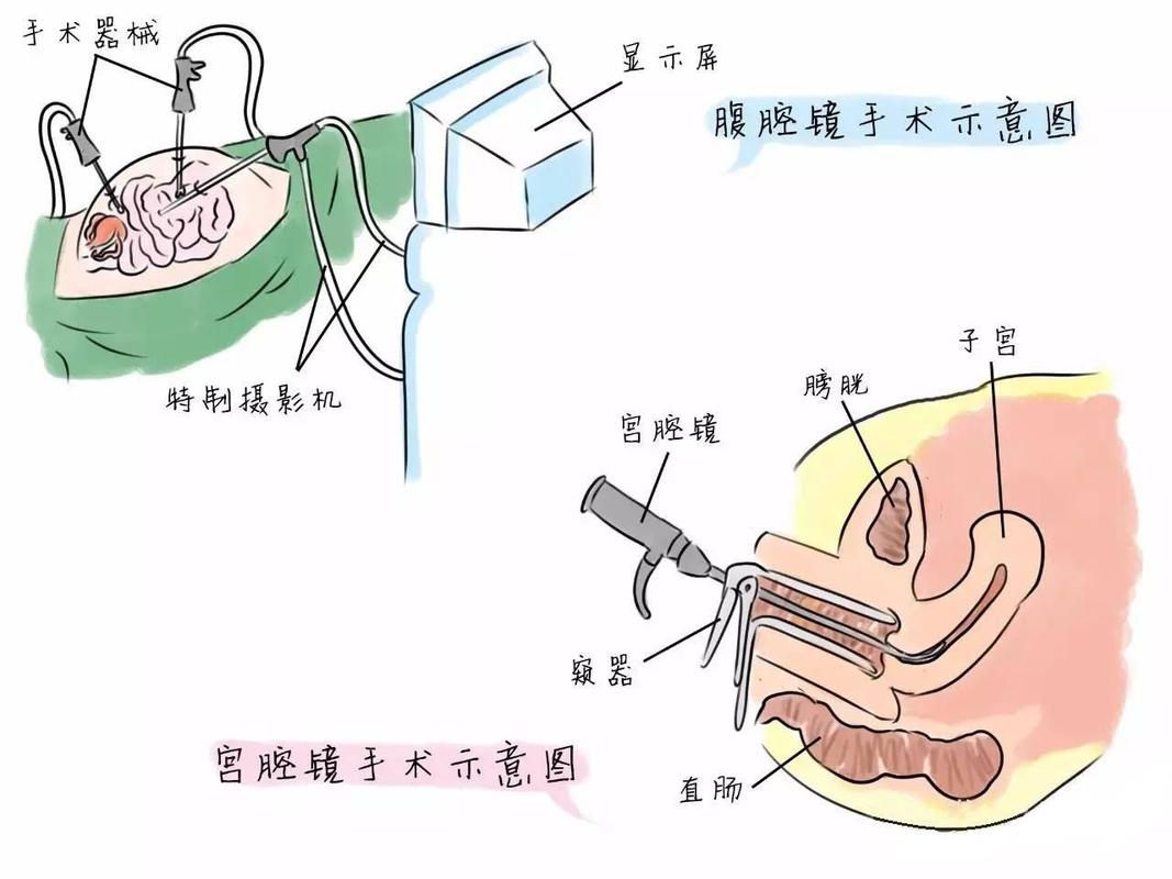 请问做完宫腔镜息肉手术，多久可以上班?应该注意什么呢？（宫颈息肉切除营养）