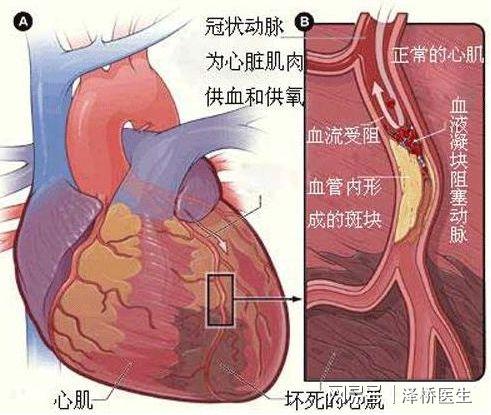 营养不良性心绞痛（营养不良会导致心肌损害吗）