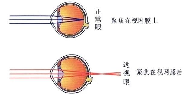 眼部营养缺乏导致近视（眼睛营养不良会引起散光吗）