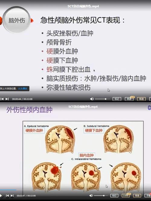 脑外伤昏迷营养（颅脑外伤昏迷5天,最适用的营养途径）