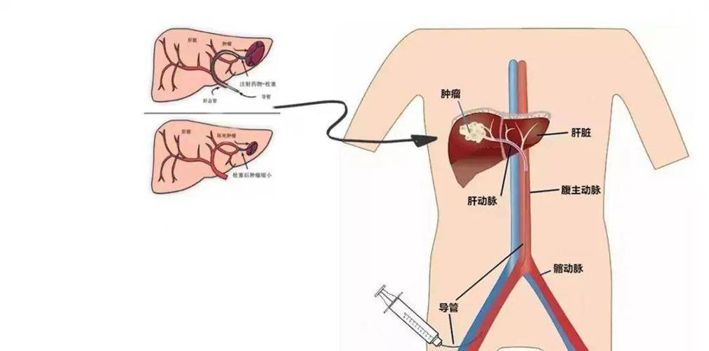 肝脏介入治疗后需要营养（肝脏介入治疗后需要营养补充吗）