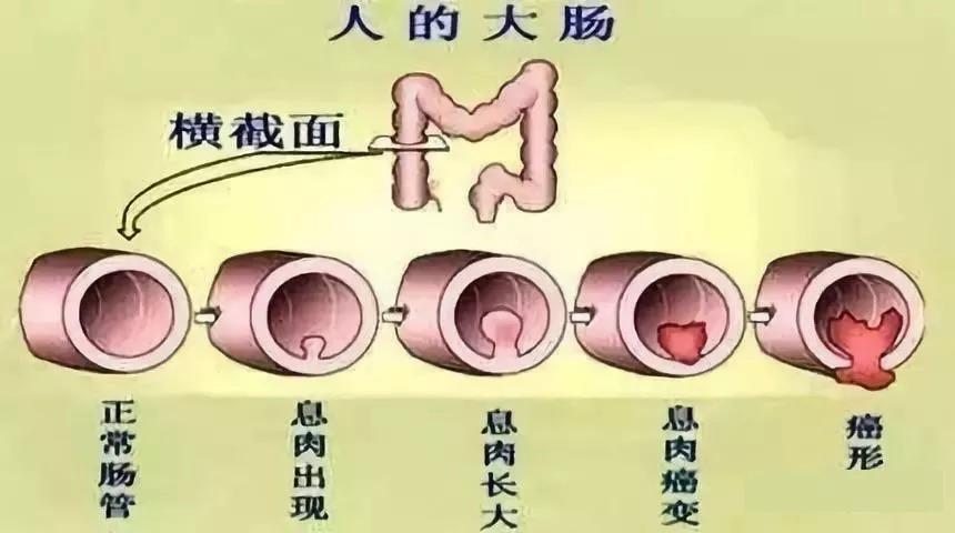 肠息肉影响营养吸收（肠息肉影响体重吗）