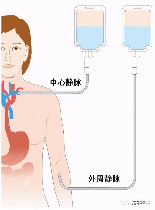 静脉高营养配了速尿（静脉注射速尿对尿量的影响）