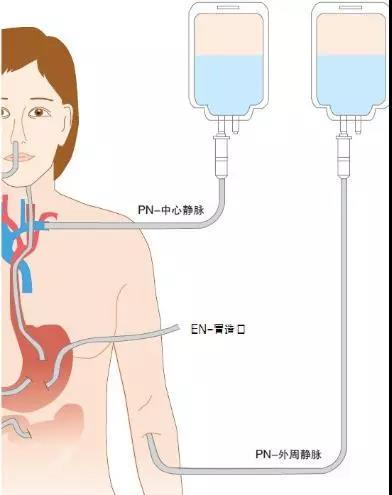 腹部肠营养管置入术（放置肠内营养管需要麻醉吗）