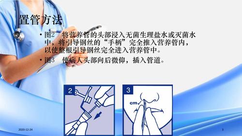 空肠营养管怎么拔（空肠营养管拔除步骤）