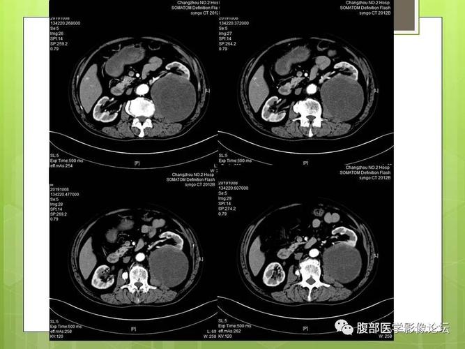 乳头状肾癌术后营养（乳头状肾癌死亡率高吗）