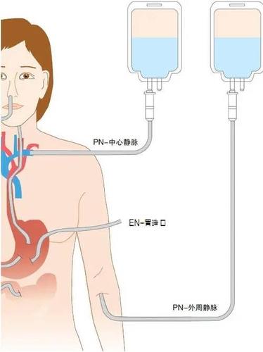 肠内营养管置入图片（肠内营养管从哪里插）
