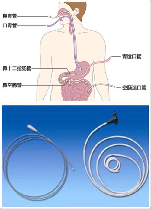 空肠营养管痛苦吗（空肠营养管难受吗）